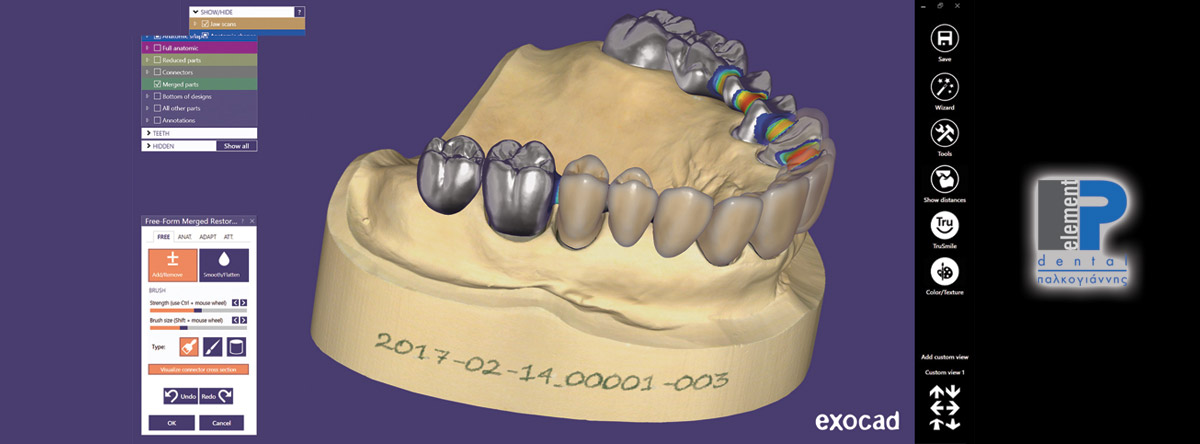 Exocad DentalCAD